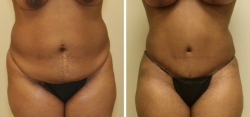 Abdominoplasty - Liposuction of Abdomen - Liposuction of Flanks- Belly Button Revision