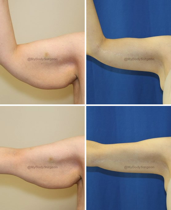 Arm Lift Before and After Photos San Diego  Dr Kaweski