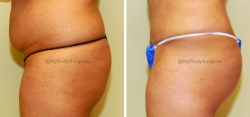 Liposuction of Abdomen - Liposuction of Flanks - Bilateral Fat Transfer to Buttocks