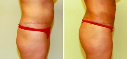 Liposuction of Abdomen -Liposuction of Flanks - Bilateral Fat Transfer to Buttocks