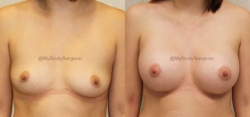 Breast Augmentation - 425 cc HP Silicone Gel Implants - Implant Placed Under Muscle - Incision in Breast Crease