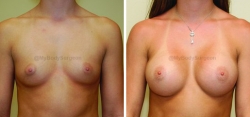 Breast Augmentation - 350 cc HP Silicone Gel Implants - Implant Placed Under Muscle - Incision in Breast Crease