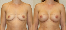 Breast Augmentation - 375 cc HP Silicone Gel Implants - Implant Placed Under Muscle - Incision in Breast Crease