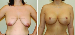 Breast Lift - Breast Augmentation - 400 cc High Profile Silicone Implants - Implant Placed Under Muscle