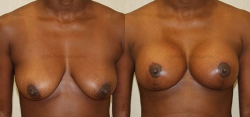 Breast Lift -Breast Augmentation - 300 cc High Profile Silicone Implants - Implant Placed Under Muscle