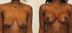 Breast Lift -Breast Augmentation - 500 cc High Profile Silicone Implants - Implant Placed Under Muscle