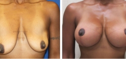 Breast Lift -Breast Augmentation