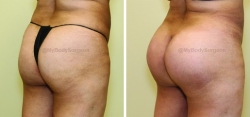 Buttock Augmentation with Implants