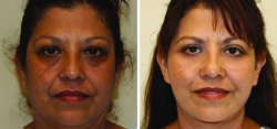 Face Lift - Upper and Lower Eyelid lift