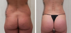 Liposuction of the Abdomen, Flanks, Lower Back, Inner & Outer Thighs