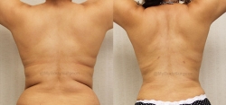 Liposuction of Upper & Lower Back