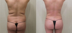 Liposuction of the Abdomen, Flanks, Upper & Lower Back, Inner & Outer Thighs