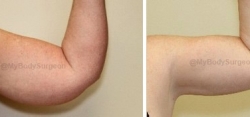 Liposuction of Upper Arms