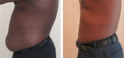 Liposuction of Abdomen, Liposuction of Flanks & Liposuction of Lower Back