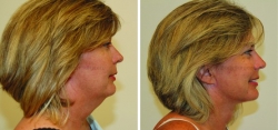 Neck Lift - Incision behind ears