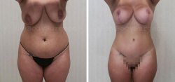 Abdominoplasty - Liposuction of Abdomen - Liposuction of Flanks