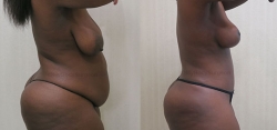 Abdominoplasty - Liposuction of Abdomen - Liposuction of Flanks - Liposuction Pubis - Liposuction of Upper & Lower Back