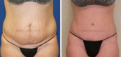 Abdominoplasty - Liposuction of Abdomen - Liposuction of Flanks - Liposuction Pubis - Belly Button Revision