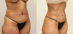Abdominoplasty - Liposuction of Abdomen - Liposuction of Flanks - Liposuction Pubis - Belly Button Revision