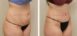 Abdominoplasty Full - Liposuction of Abdomen - Liposuction of Flanks - Liposuction Pubis - Belly Button Revision