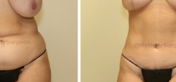 Abdominoplasty - Liposuction of Abdomen - Liposuction of Flanks - Belly Button Revision