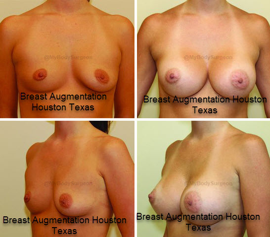 Breast Augmentation Houston Texas